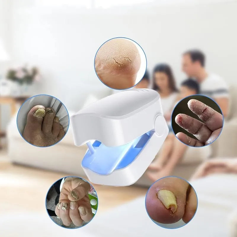 Tilas™ LightFix| Fototerapia para Uñas Dañadas