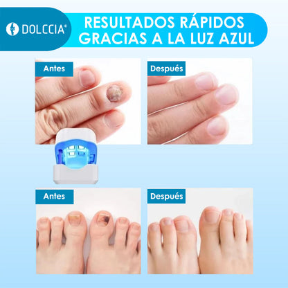 Tilas™ LightFix| Fototerapia para Uñas Dañadas
